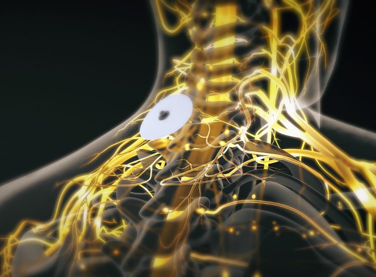 traitement neuromodultaion douleurs chroniques stress