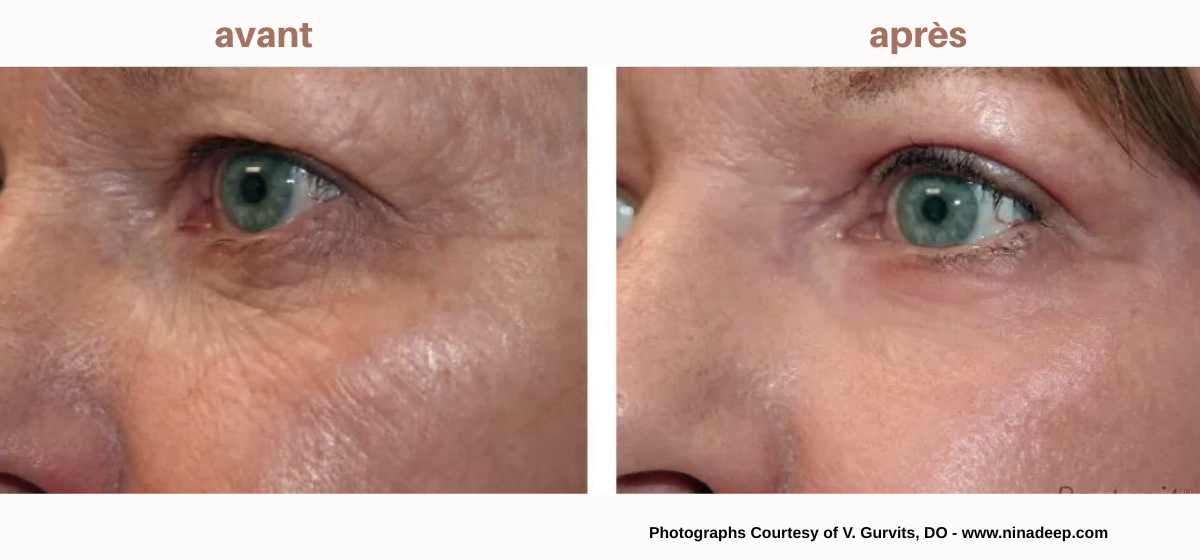 NeoGen Plasma pupières inférieures NeoGen Plasma pupières inférieures