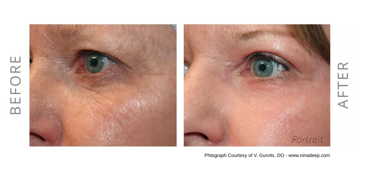 NeoGen Plasma pupières inférieures
