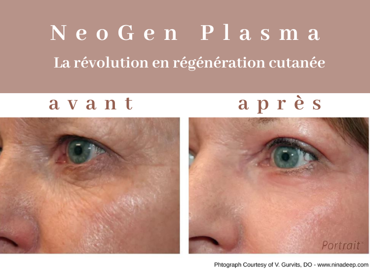 accueil NeoGen plasma