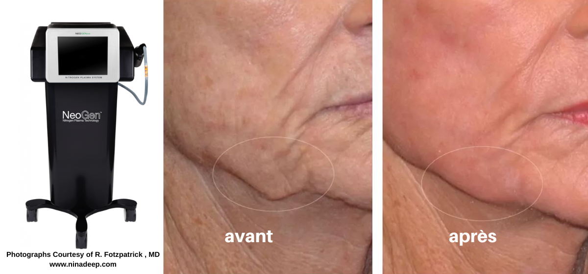 ovale visage NeoGen Plasma ovale visage NeoGen Plasma